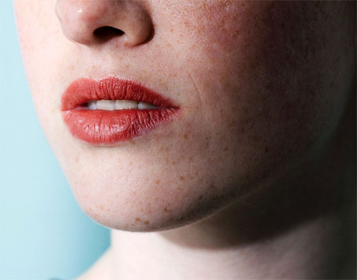 ACNE