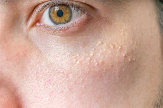 Desarrollo de manchas hipercrómicas y acrómicas
