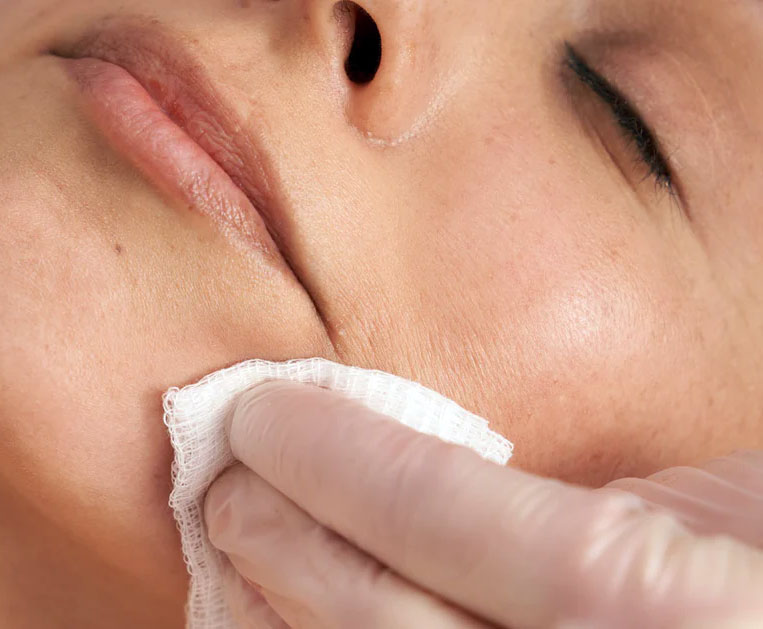 PEELING DE FENOL