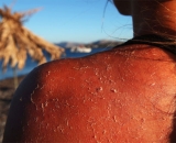 La cultura del bronceado y el dao actnico