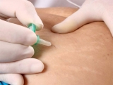 Carboxiterapia y celulitis