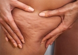 La celulitis, el resultado de muchos factores