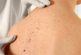 Desarrollo de manchas hipercrmicas y acrmicas